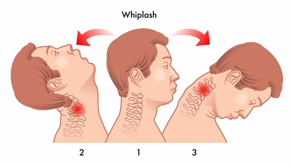 A picture of how a whiplash injury from a car accident is sustained. 